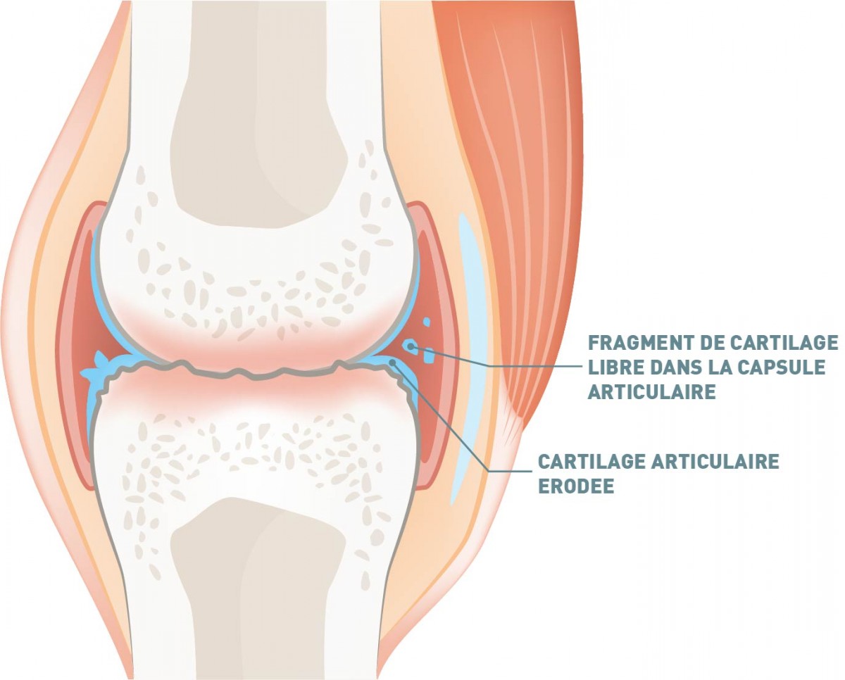 articulation arthrosique